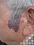 Image de l'angiome plan facial