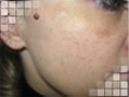 Melasma
